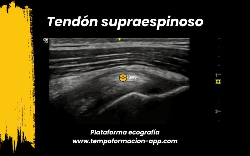 1. Ecografia tempo formacion manguito rotador tendon supraespinoso infraespinoso redondo menor subescapular.png